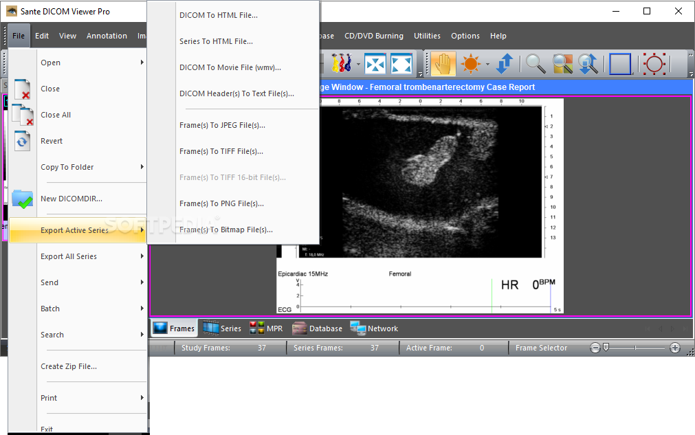 download the new version Sante DICOM Viewer Pro 12.2.5